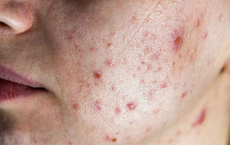 A persons cheek showing signs of acne